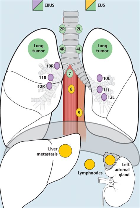 Illustration Of Mediastinal Lymph Node Stations And Abdominal Regions
