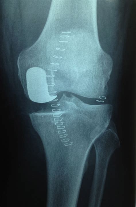 Knee — Hemiarthroplasty Avalon Orthopaedic