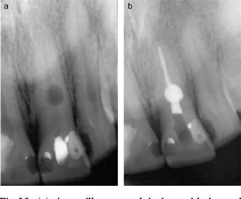 Internal Resorption Tooth