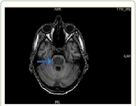T1 Weighted Mri Showing Central Hypointense Lesion In Pons Download