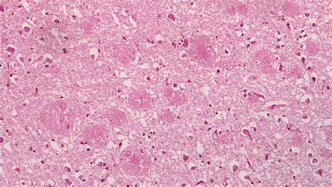 Plaques Proteins And The Causes Of Alzheimers Disease