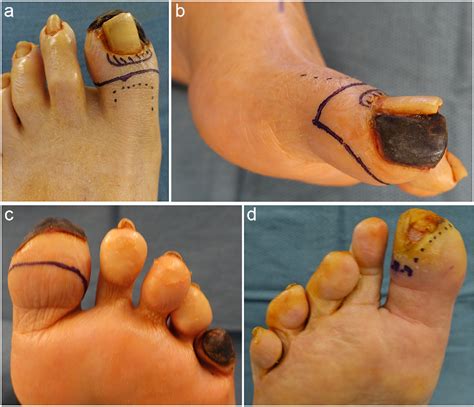 Figure 2 From Distal Syme Hallux Amputation For Tip Of Toe Wounds And
