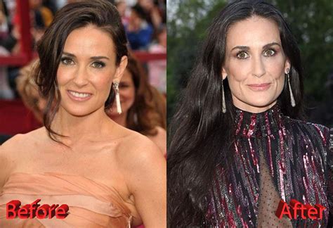 demi moore plastic surgery before and after photo