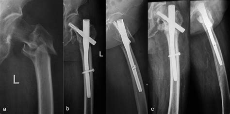 Risk Factors For Implant Failure After Fixation Of Proximal Femoral