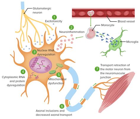 Esclerose Lateral Amiotrófica Fisiopatologia