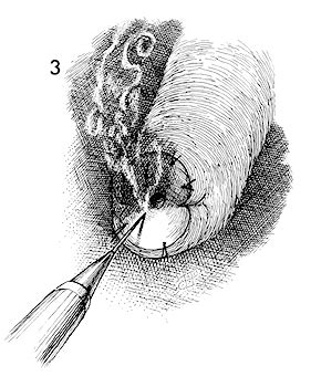 What does sturmdorf suture mean? Conization of Cervix