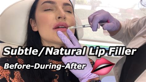 Naturalsubtle Lip Filler Vlog Juvederm Volbella Youtube
