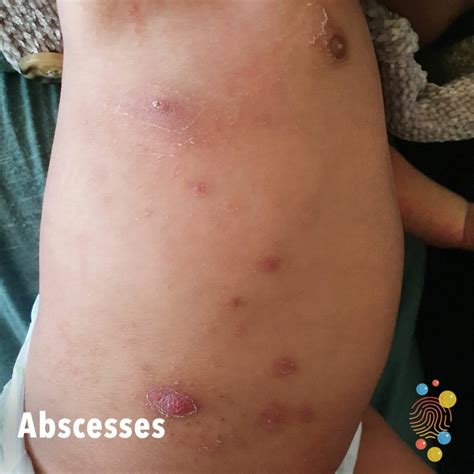 Fever As Related To Abscess Pictures