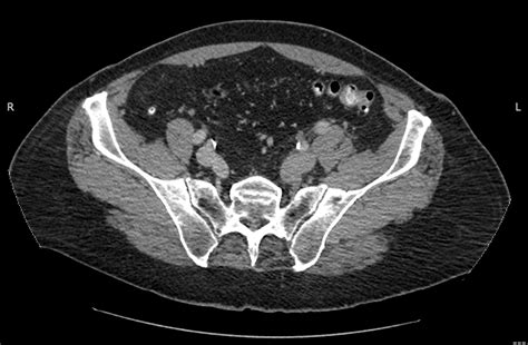 May Thurner Syndrome Presenting As Recurrent Isolated Left Sided Deep