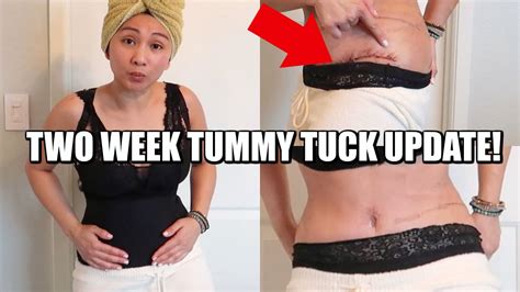 2 Week Post Op Tummy Tuck Update Youtube