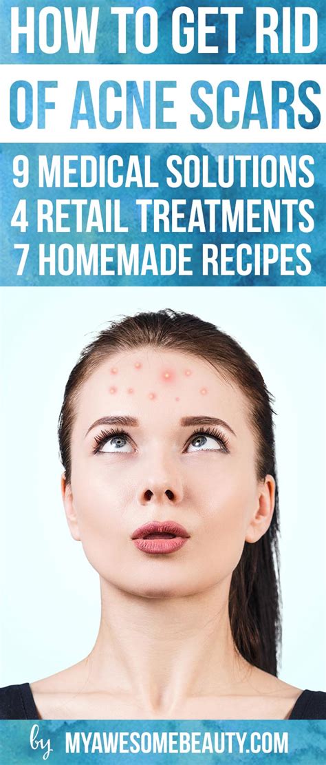 How To Get Rid Of Acne Scars Fast The 20 Best Treatments