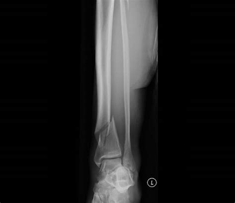 Lower Limb Fractures Orthopaedics Trauma London
