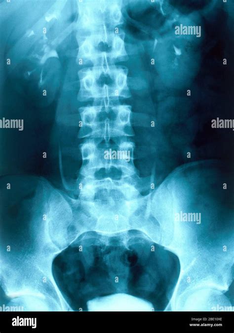 X Ray Urinary System Normal Hi Res Stock Photography And Images Alamy