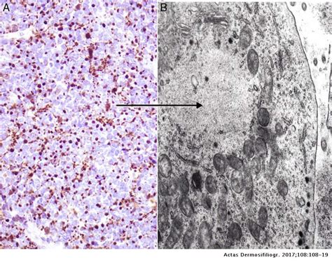 Merkel cell carcinoma (mcc) and many other skin cancers often can be found early, when they're small, haven't spread, and are likely to be easier to treat. Merkel Cell - Update On Merkel Cell Carcinoma Epidemiology ...