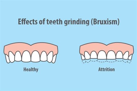 Teeth Grinding Causes And Treatments Oakton Va