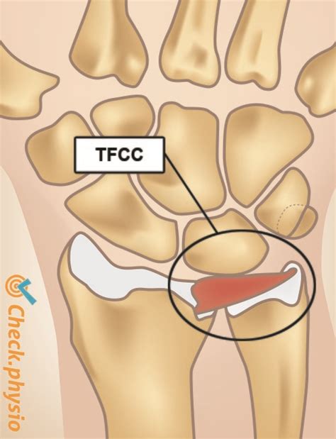 Tfcc Injury Physio Check