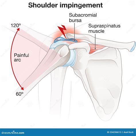 Shoulder Impingement Labeled Stock Illustration Illustration Of Deposits Cartilage