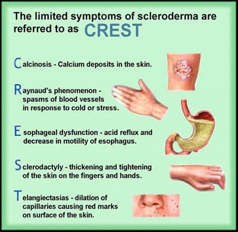 Scleroderma Myositis Support And Understanding