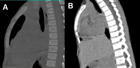 Ct Non Contrast Images Sagittal Section Showing Sternal Position And