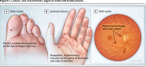 Figure 1 From Management Considerations In Infective Endocarditis A