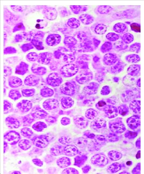 Under The Microscope The Hallmark Of Burkitt Lymphoma Is The Presence