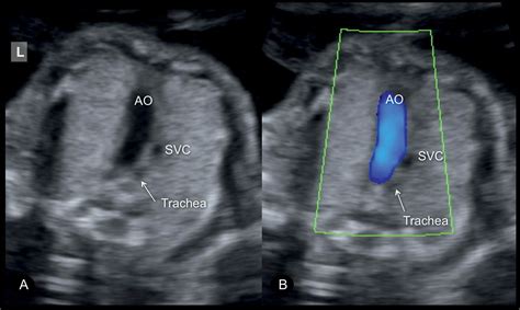 Transposition Of Great Vessels Fetal Ultrasound