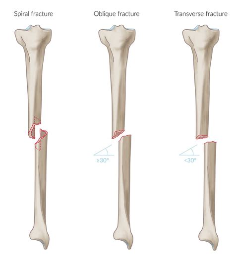 Multiple Bone Fractures