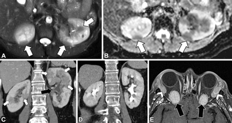 Renal Neoplasms In Young Adults Radiographics