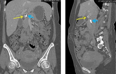 Mirizzi Syndrome Radiology Cases