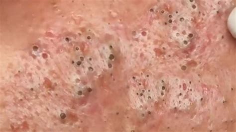 It gently exfoliates your skin to remove the blackheads and pimples. How to get rid of blackheads Awesome blackhead popping - a ...