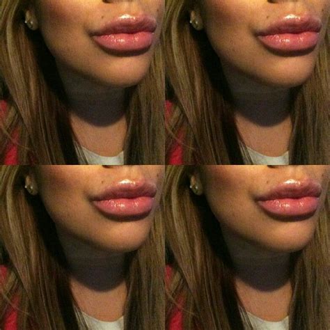 Restylane Juvederm Botox Lip Injections Lip Plumper Plumping Fake Lips Plump Lips