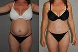 Breast Augmentation Doctors Near Me Pictures