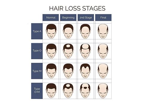 Male Pattern Baldness Causes Symptoms And Treatment Peak Human