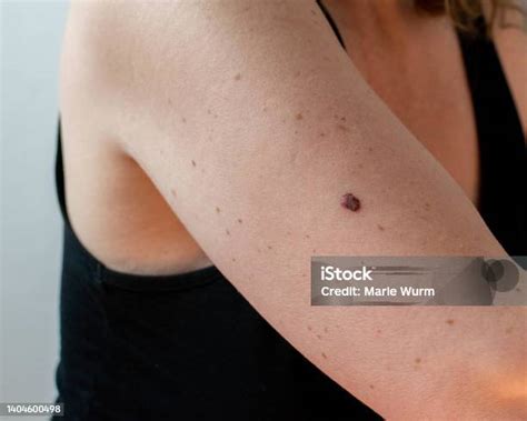 Abnormal Mole On Arm Skin Cancer Screening Stock Photo Download Image