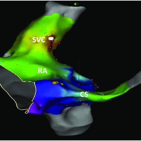 Delay in this pathway leads to prolongation of the p. (PDF) Biatrial Flutter Circuit Involving an Anomalous ...