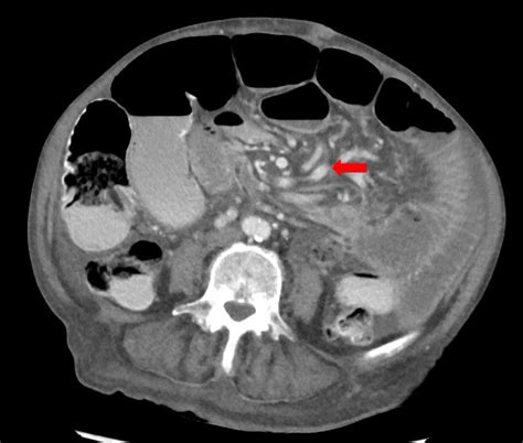 Cureus Primary Small Bowel Volvulus An Unusual Cause Of Small Bowel