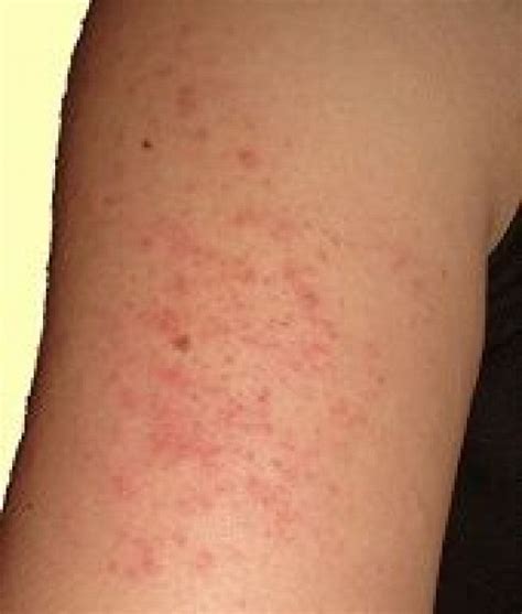 Keratosis Pilaris Is A Common Type Of Arm Acne It Presents With Small
