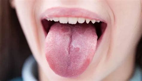 Sore Tongue Causes Symptoms And Treatments New Life Ticket Part 10