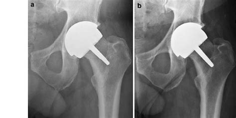 Hip Resurfacing Anteroposterior Radiographs— Post Operatively A Left