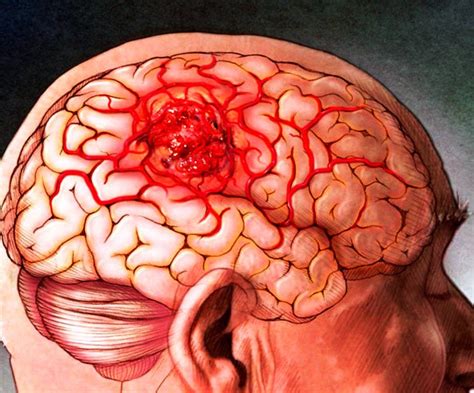 Causas De Un Tumor En El Cerebro Todo Lo Que Debes Saber