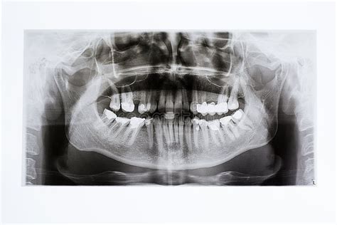 X Rays Of The Jaw And Teeth Stock Image Image Of Xray Radiology