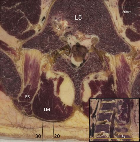 40 Year Old Specimen Cross Sectional View Through Mid Spinous Process