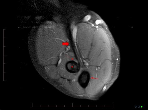 Atypical Scan Angles In Musculoskeletal Mri Radsource