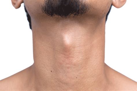 Tracheal Shave Adams Apple Reduction Dr Stephen Kleid Fracs