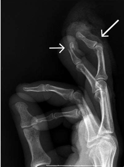 Mallet Fracture X Ray Mallet Finger Litfl Trauma Library A Hand