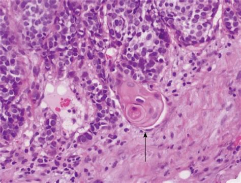 Figure 2 From Thyroid Carcinoma Showing Thymus Like Differentiation
