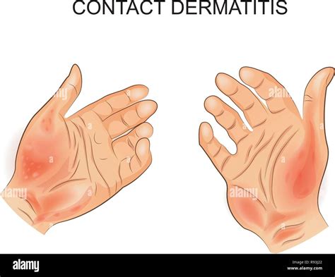 Vector Illustration Of Contact Dermatitis Allergy Dermatology Stock