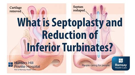 Septoplasty And Turbinate Reduction Renew Physical Therapy