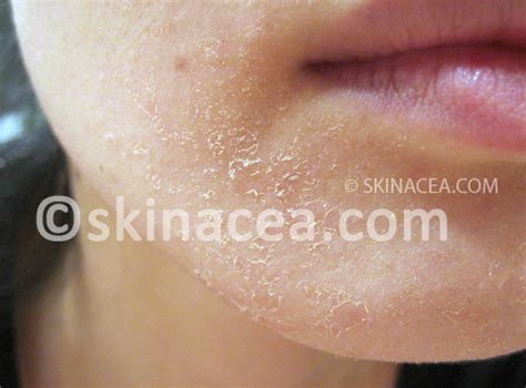 How Do I Get Rid Of Dead Skin Cell Flakes On My Face General Acne
