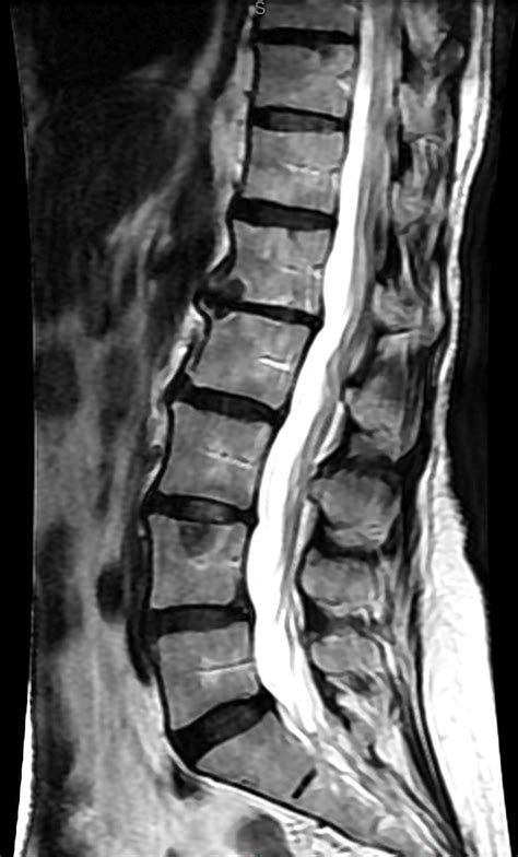 Mri Lumbar In Patient Hnp Radiology Imaging Hot Sex Picture